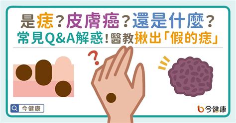 左眼下突然長痣|是痣or皮膚癌？醫「1張圖秒對照」 長這2部位最危險 